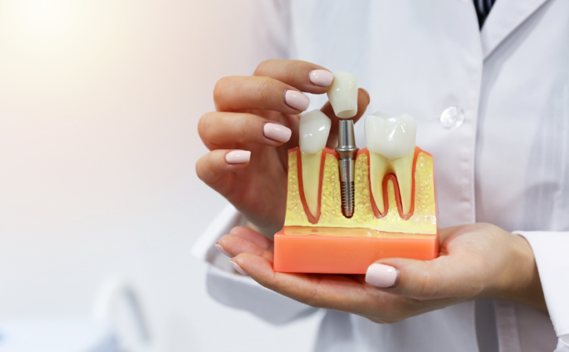 Kā rūpēties par zobu implantiem?
